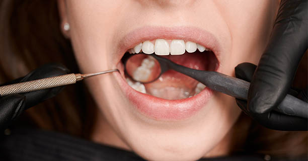 Tooth Bonding